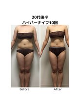 ビハダエステ 町田店(BIHADAエステ)/【B/A】20代後半ハイパーナイフ