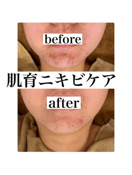 マルコ(marco)/ニキビケア　症例