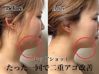 アンドエス 六本木(and S.)/たった一回で二重アゴ改善☆