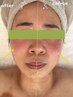 【日焼け後72時間が鍵】【2名/日限】集中美白×肌リカバリーケア22000→16700