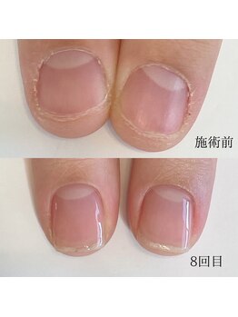 プライベートネイルサロン ママネイル(mamanail)/最強のネイルケア★お客様症例