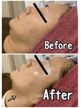 ブランシュール/ハイドラフェイシャル×導入