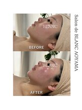サロン ド ブラン アオヤマ(Salon de BLANC AOYAMA)/アクネケア・赤みケア・毛穴ケア