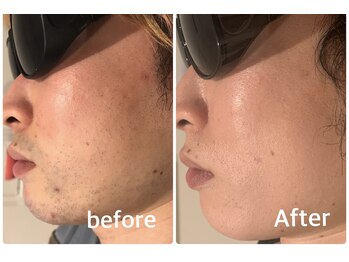 メンズ シャンティ(Men s SHANTI)/【20代男性】脱毛　Before/after