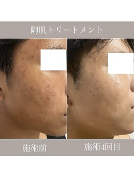 ブラックボックス(BLACK BOX)/那珂市Y様10代