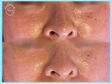 ハーブピーリング 名古屋/毛穴の黒ずみごっそり！！