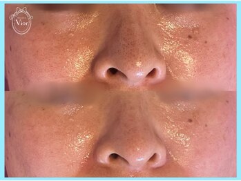 ハーブピーリング 名古屋/毛穴の黒ずみごっそり！！