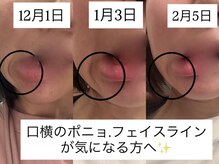 サロン ドロップ 上小田井(Salon drop)/口横のポニョ.たるみ改善