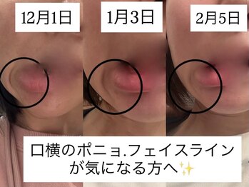 サロン ドロップ 上小田井(Salon drop)/口横のポニョ.たるみ改善
