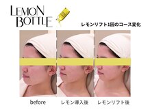 クリニカルエステ イーズ 小倉リバーウォーク北九州デコシティ店/FACEレモンボトル変化写真-2