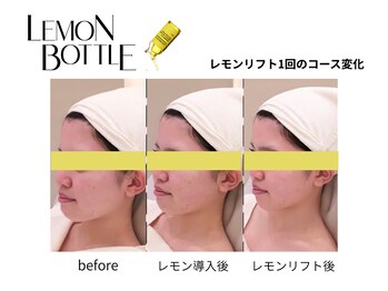 クリニカルエステ イーズ 小倉リバーウォーク北九州デコシティ店/FACEレモンボトル変化写真-2