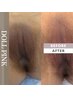 最先端韓国式メラニンケア/ローマピンク（ドールピンク）　Iライン￥55,000