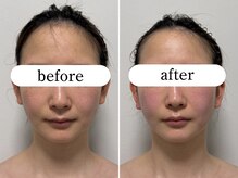 ワンエストサロン(One est.salon)/頬顎下before after
