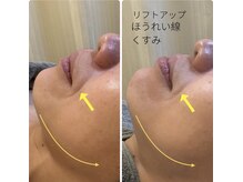 ほねつぎ一休さん 宇品店/速攻小顔フェイシャル