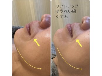 ほねつぎ一休さん 宇品店/速攻小顔フェイシャル