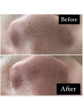 フフレ(fufre)/【オプション】黒ずみ除去¥1,100