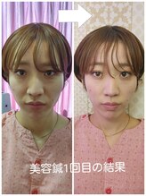 アイビソウ 所沢(IBISOU)/小顔美容鍼