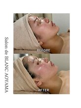 サロン ド ブラン アオヤマ(Salon de BLANC AOYAMA)/アクネケア・赤みケア・毛穴ケア