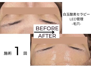 ベガ(Vega)/白玉酸素セラピーLED