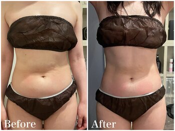 サロンドフェイス(Salon de Faith)/【ラジオ波】10回施術♪