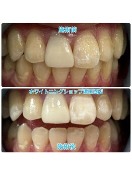 ホワイトニングショップ 津田沼店/before&after美白ホワイトニング
