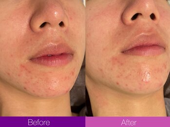 クレヴィア バイ サイバーエステ(CREBIA)/ 顎ニキビに【ビオフィート】