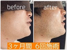 都度払いなので負担なし♪メンズ髭効果抜群！即効性◎