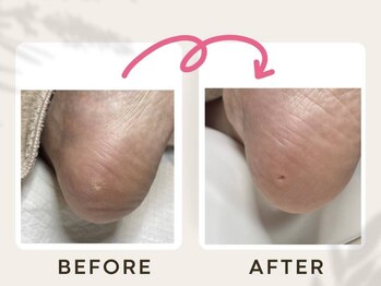 ドクターネイル爪革命 恵庭店/魚の目ケア