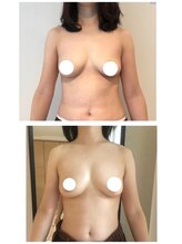 美人バスト 本厚木店/バストアップ◇症例◇