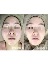 エミルカ 鹿児島店(EMILUCA)/ハーブピーリング　顔　