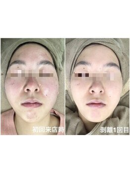 エミルカ 鹿児島店(EMILUCA)/ハーブピーリング 顔