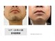サロン ルアナ(salon luana)の写真/脱毛は身だしなみの一つに◎メンズ脱毛で清潔感UP！ヒゲ剃り負けの心配なし♪最新美肌マシンで清潔感UPに！