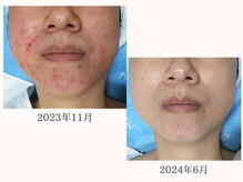 りりあす/肌のお悩みを改善したい方！