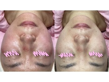 じゅえる/シミケアエステの効果 次へ→