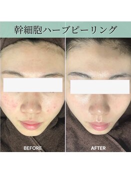 スキンベイビー 浦和店(Skin Baby)/徹底的肌質改善◎