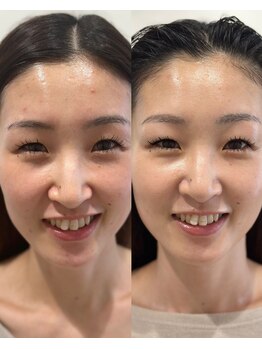 レボン(rebon)/ビフォーアフター