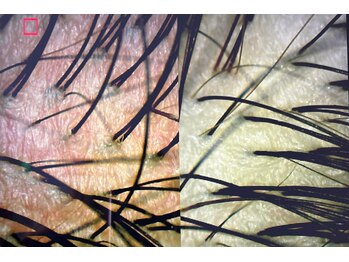 サナデア(Sanadea)/頭皮スコープのbeforeとafter