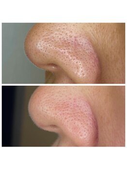 レア 武蔵小杉(LEA)/＼4/20 NEW／毛穴洗浄コース