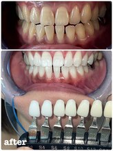 エクシアホワイトニング 札幌中島公園店/Before After［ホワイトニング］