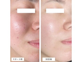 エキュレ ジャーニー トゥ マイ トータル ビューティー(equrer)/モリーズプロを使って30日