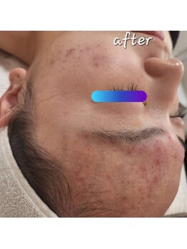 ピウリ(PIURI)/ニキビケアは2回目で一目瞭然☆