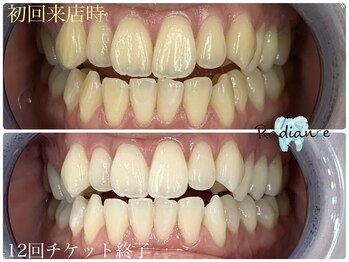 札幌セルフホワイトニング ラディアンス(Radiance)/12回チケット終了