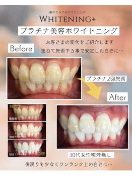 ホワイトニングプラス(Whitening+)/やっぱり人気