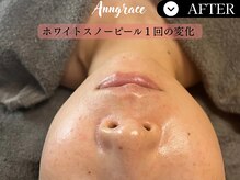 アングレイス(Anngrace)/【白玉スノーピール】/After