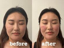 ソラナ(Solana)/100本美容鍼