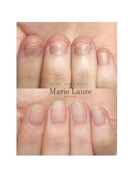 マリーロール 天王寺店(Marie Laure)/深爪矯正/自爪育成/ネイルケア