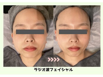 バベルトータルビューティー 北堀江店(Babel Total Beauty)/ラジオ波フェイシャル