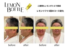 クリニカルエステ イーズ 小倉リバーウォーク北九州デコシティ店/FACEレモンボトル変化写真-3