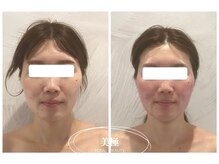 美極 銀座店/銀座/小顔コルギ/小顔矯正