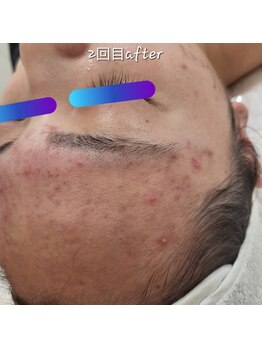 ピウリ(PIURI)/ニキビケアは2回目で一目瞭然☆